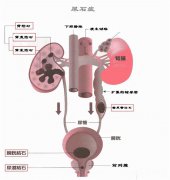 痛痛痛！得了输尿管结石怎么办？