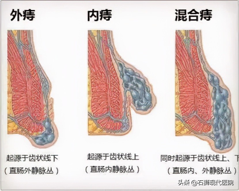 得了痔疮到这里来，安全又疗效好！石狮人早知道就少遭罪