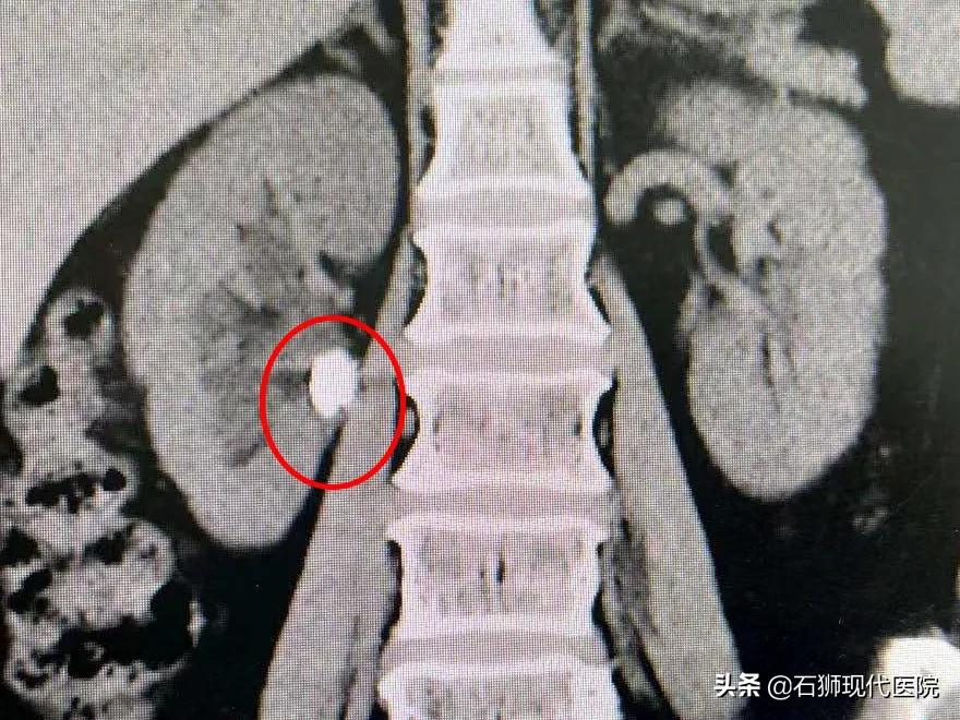 腰痛难耐？血尿不止？有这些情况马上到医院就诊，肾会感激你