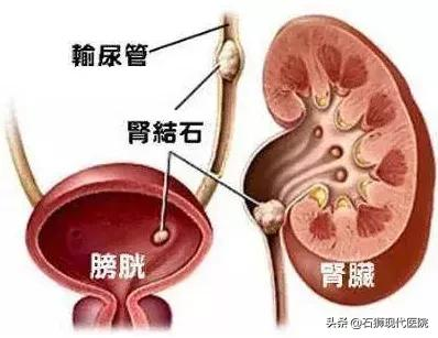 腰痛难耐？血尿不止？有这些情况马上到医院就诊，肾会感激你