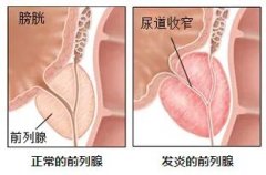 前列腺炎的4个症状，早知道~