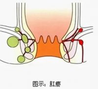 肛痿，据说它比痔疮危害大！