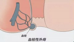 肛门处长的“紫葡萄”——血栓性外痔