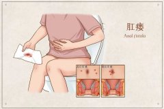 肛瘘如何形成的？又是如何分类的？