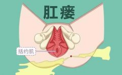 肛瘘从何而来？为什么不能自愈？