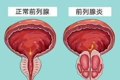 预防 | 前列腺疾病，做到6个好习惯