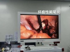 小毛病大隐患，老年人得阑尾炎千万不