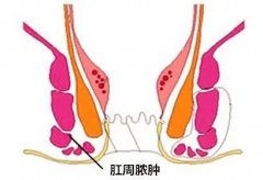 为什么我痔脱出肿大，便血，有血性分