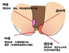 最“凶险”的痔疮长什么样？