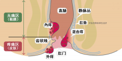 肛门痒、便便疼、带血丝......不注意这