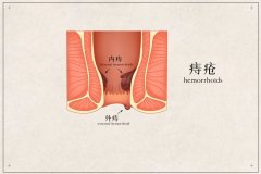 到底什么是痔疮？该怎么对付痔疮呢？