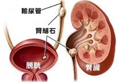 结石与这些有关，想要远离疯狂的“石