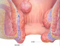 痔疮的三种类型：内痔、外痔、混合痔