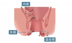 得了痔疮会出现哪些症状？