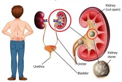 肾结石突然发作，两个动作帮你快速缓